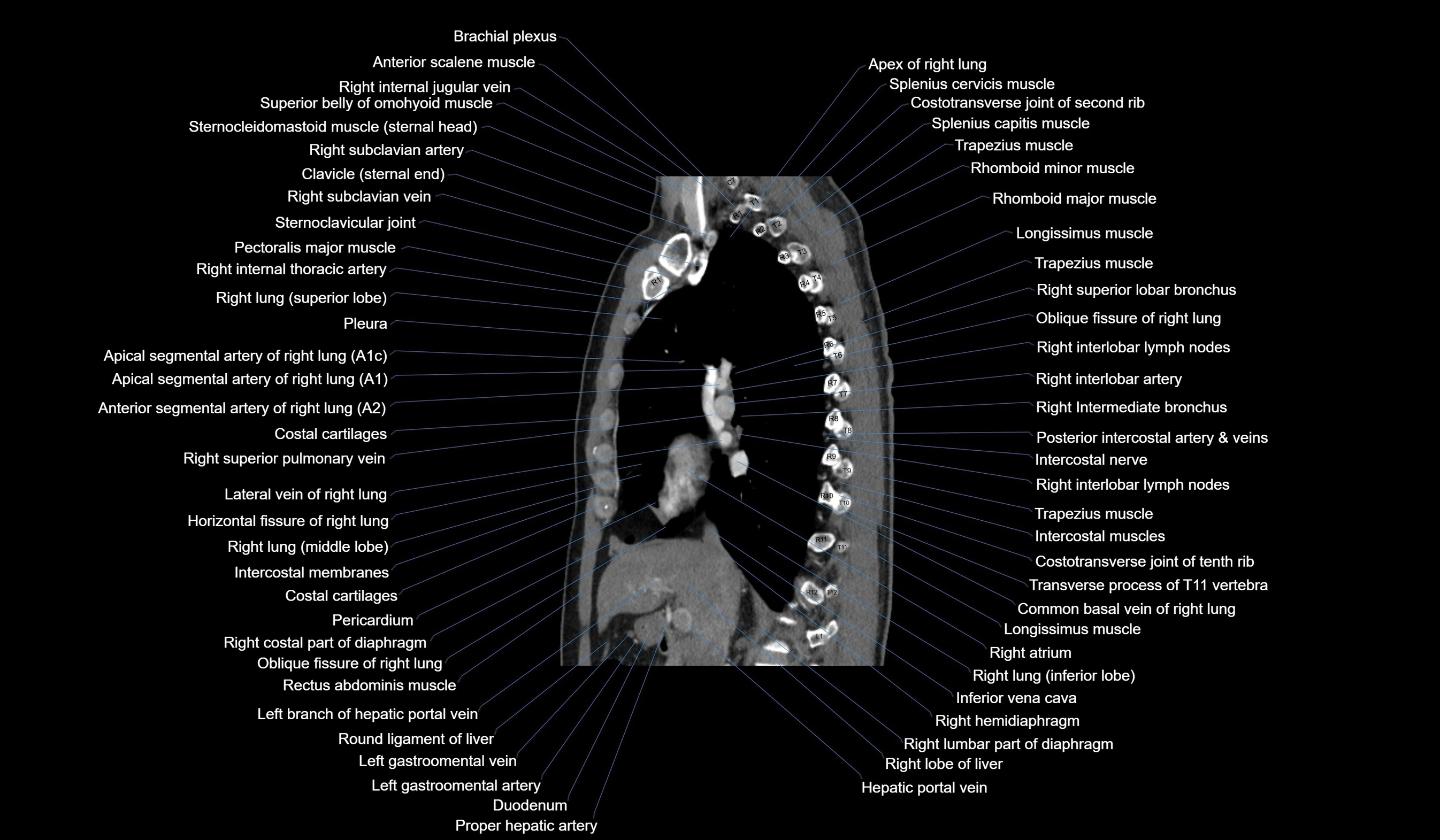 CT chest (thorax) labelled sagittal cross sectional anatomy radiology image-00061.webp